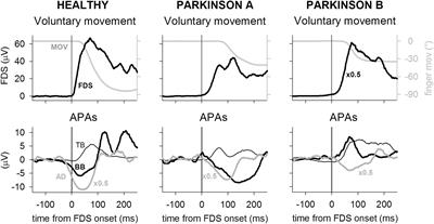 Disrupt of Intra-Limb APA Pattern in Parkinsonian Patients Performing Index-Finger Flexion